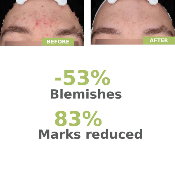 A-derma Biology AC Night Peel Anti-Blemish Serum 30ml